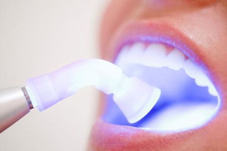 blanqueamiento dental implantes dentales clinica dental caparroso navarra