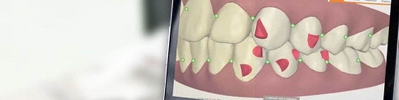 ventajas ortodoncia invisible implantes dentales
