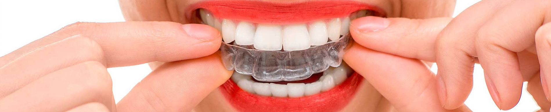 tratamientos dentales clinica dental caparroso macrident navarra